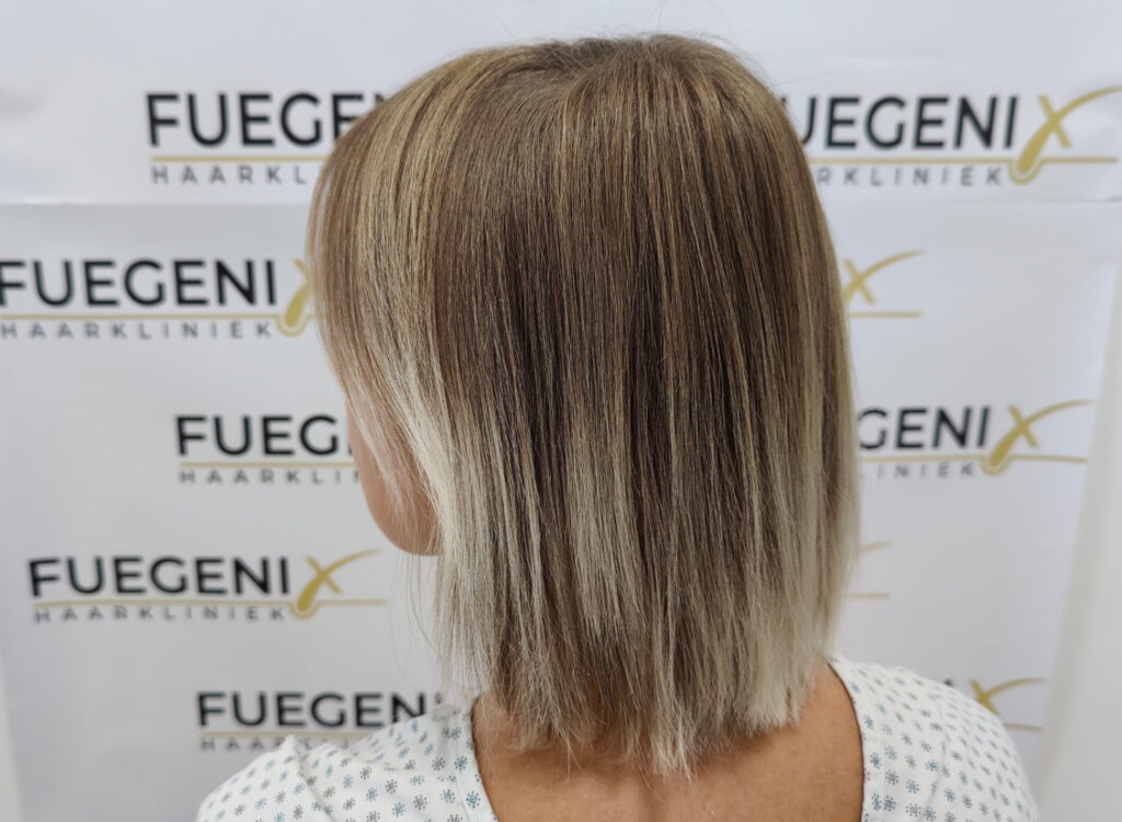 Female Hairline Lowering FUE