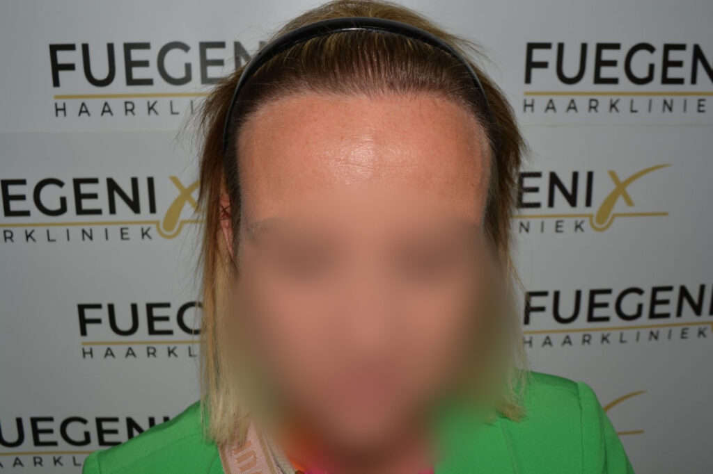 Female Hairline Lowering FUE