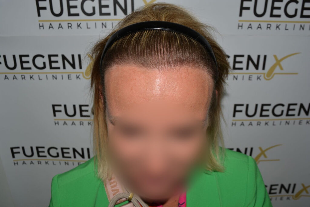 Female Hairline Lowering FUE