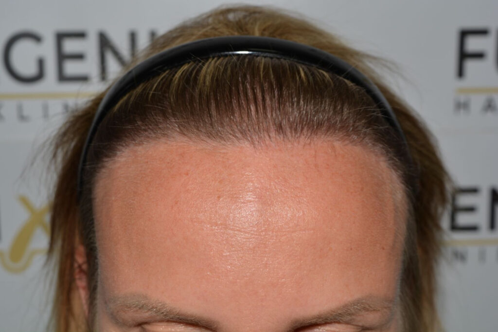 Female Hairline Lowering FUE