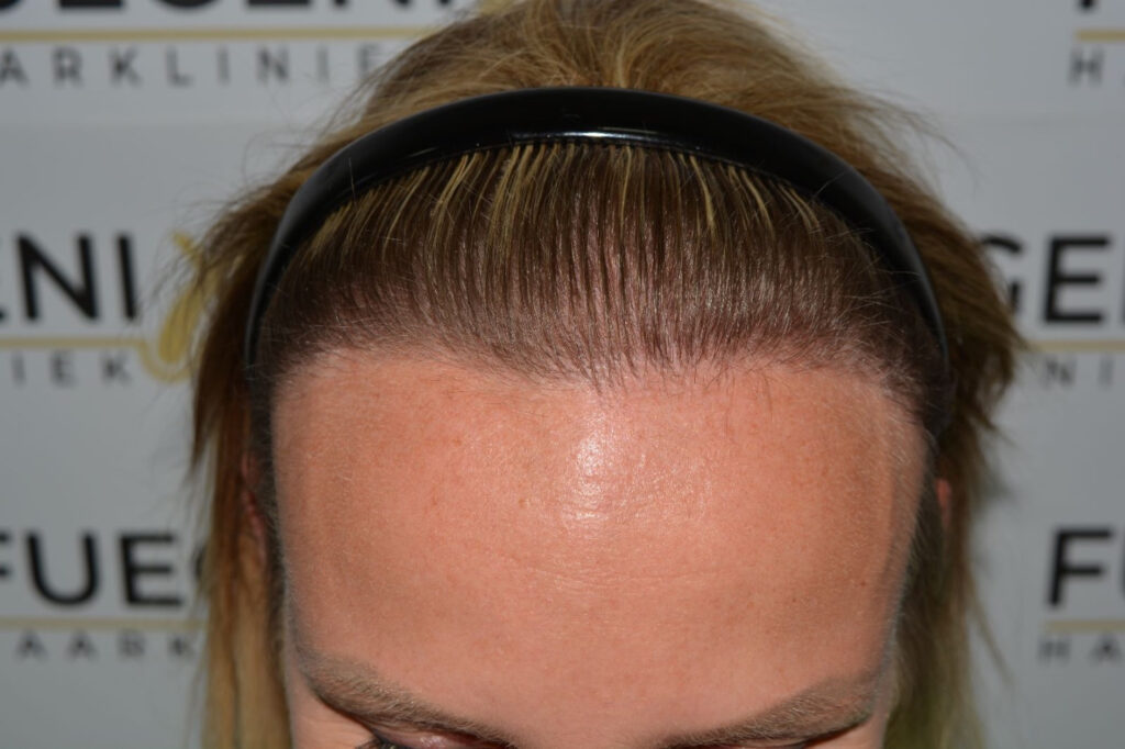 Female Hairline Lowering FUE