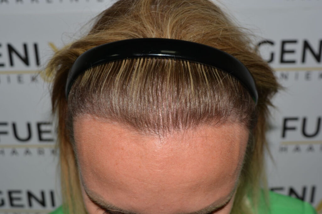 Female Hairline Lowering FUE