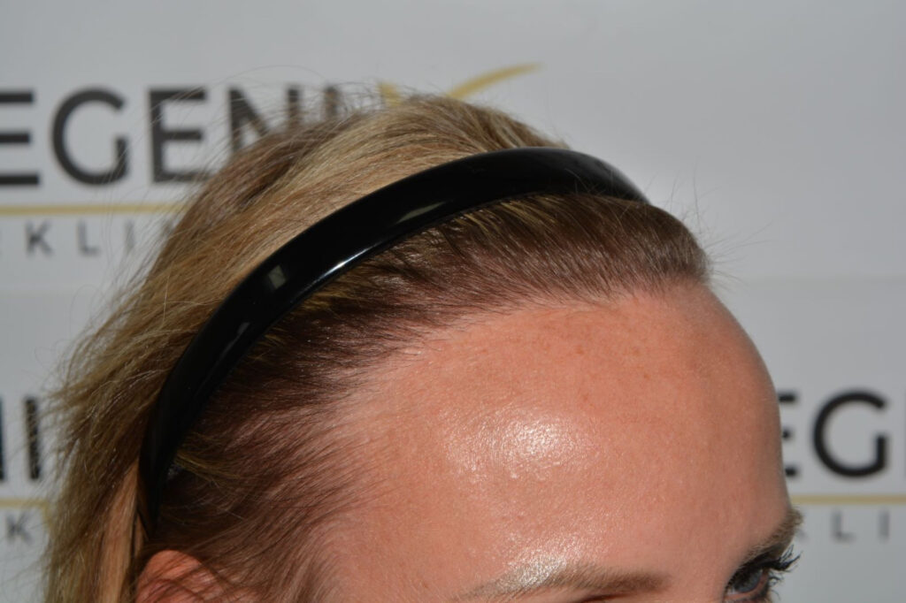 Female Hairline Lowering FUE