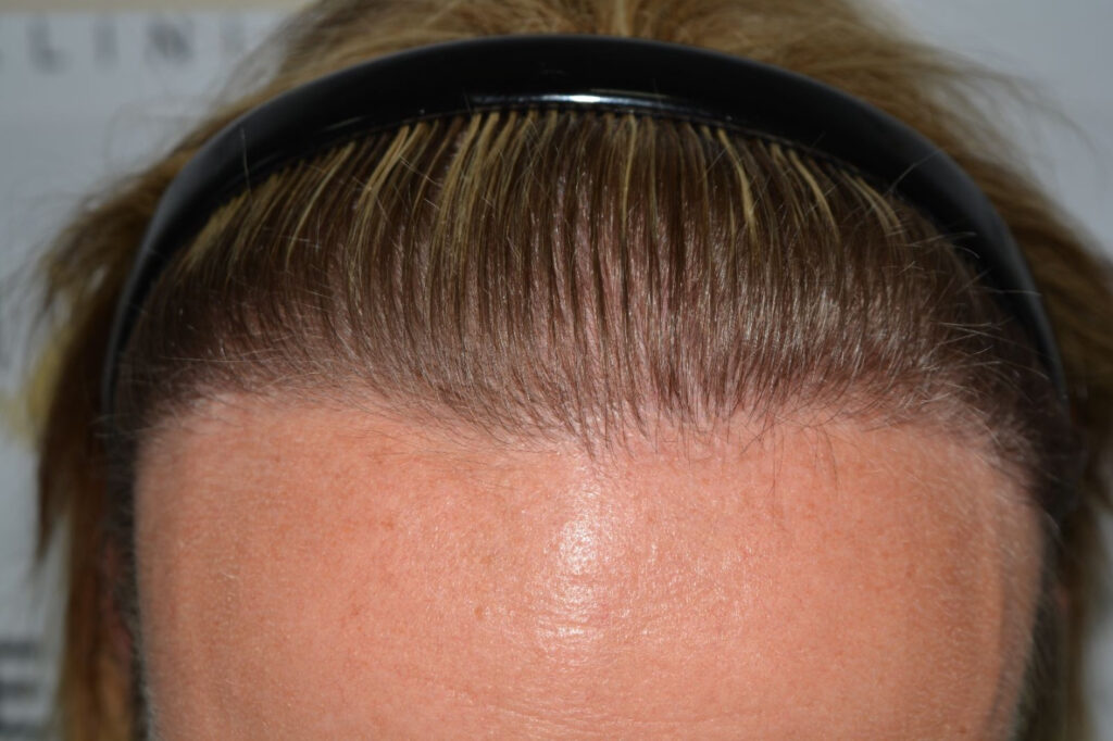 Female Hairline Lowering FUE