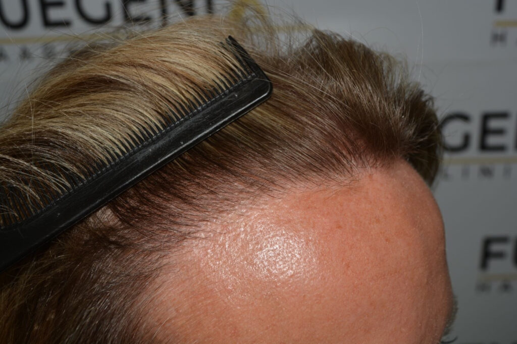 Female Hairline Lowering FUE