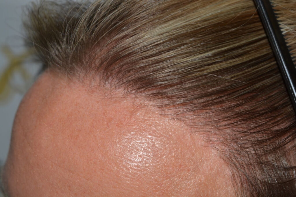 Female Hairline Lowering FUE