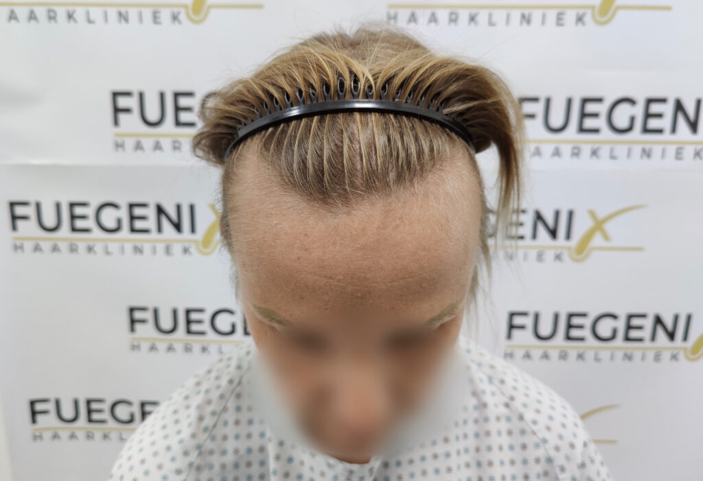 Female Hairline Lowering FUE