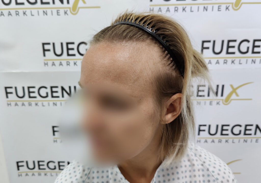 Female Hairline Lowering FUE