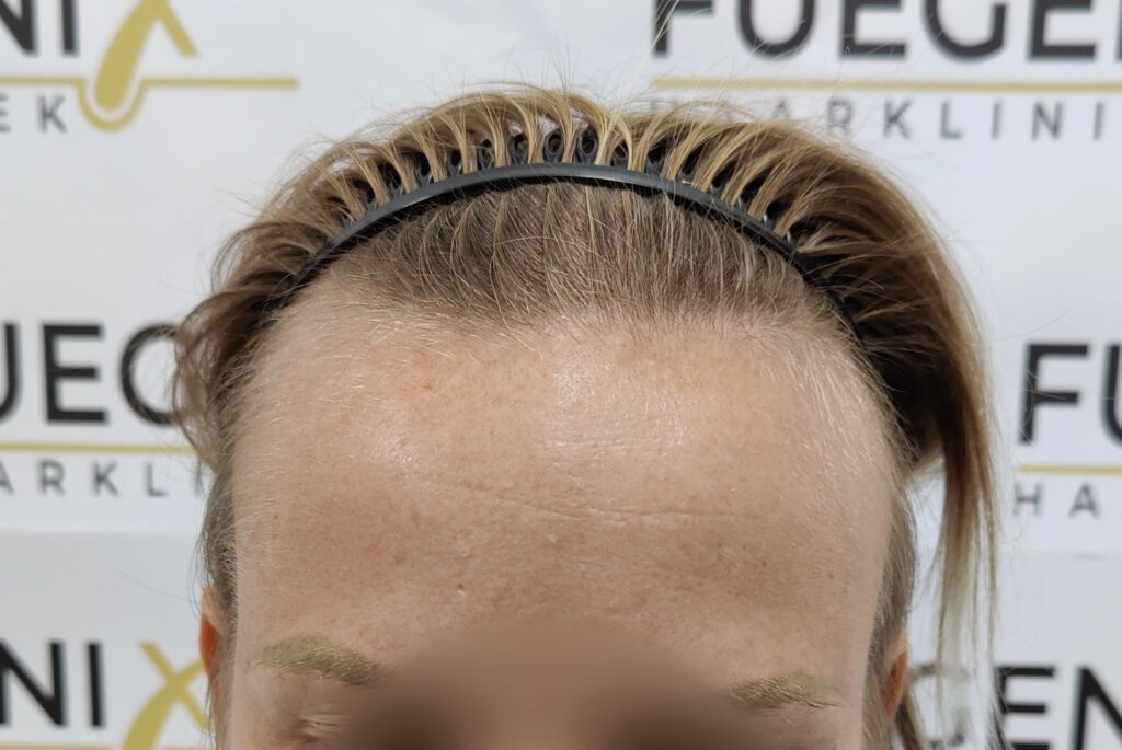 Female Hairline Lowering FUE