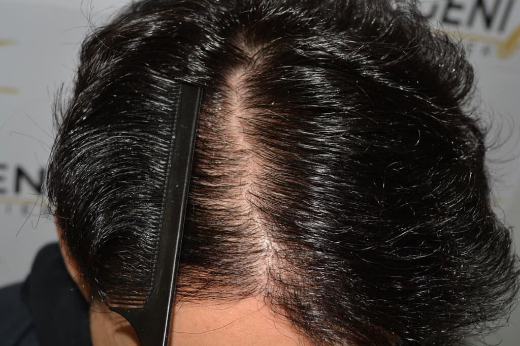 One Surgery Repair