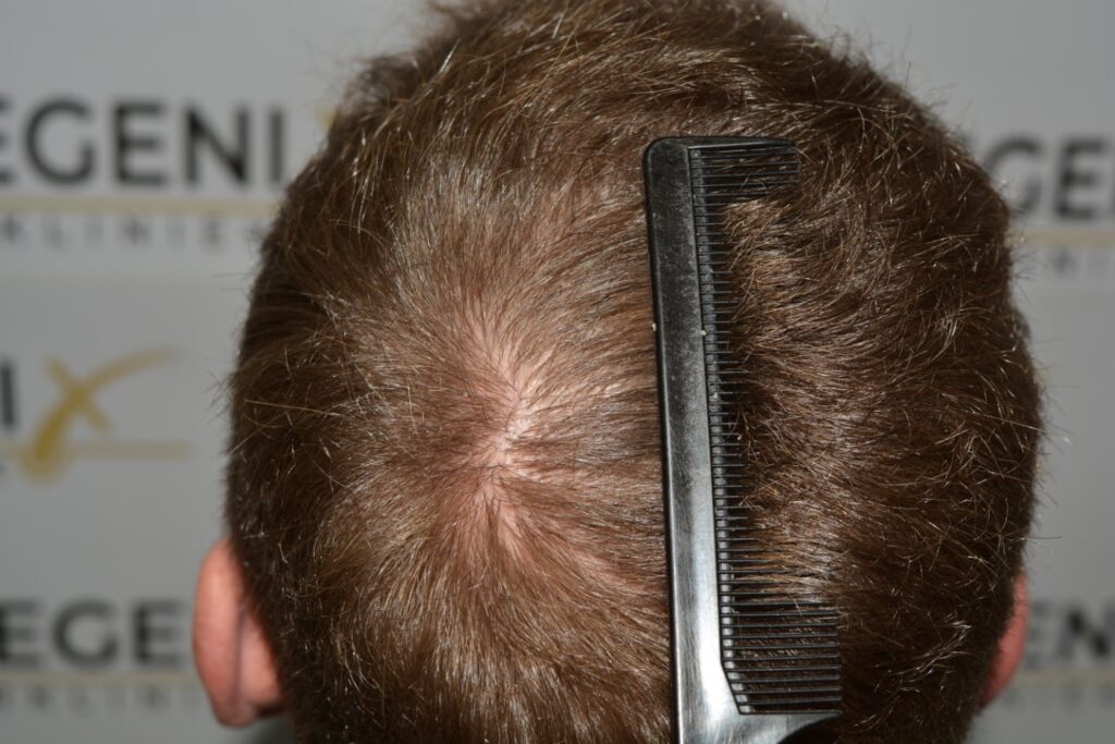 Next Level Crown Comb Through