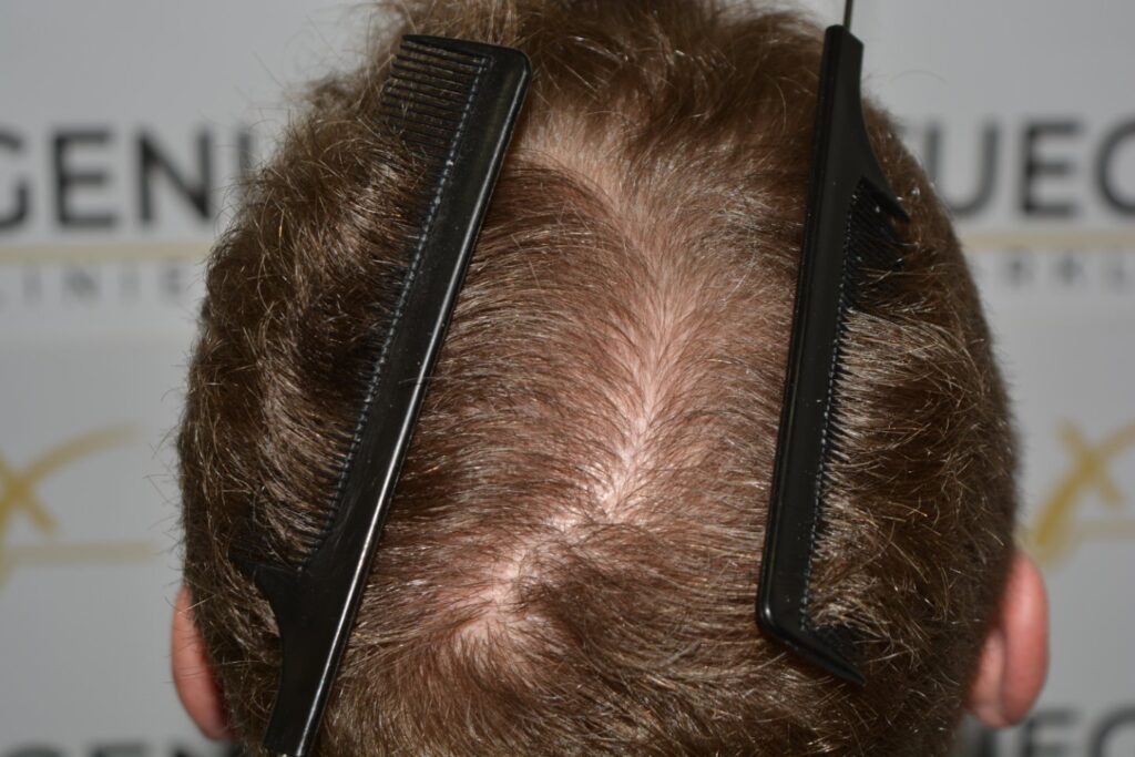 Next Level Crown Comb Through