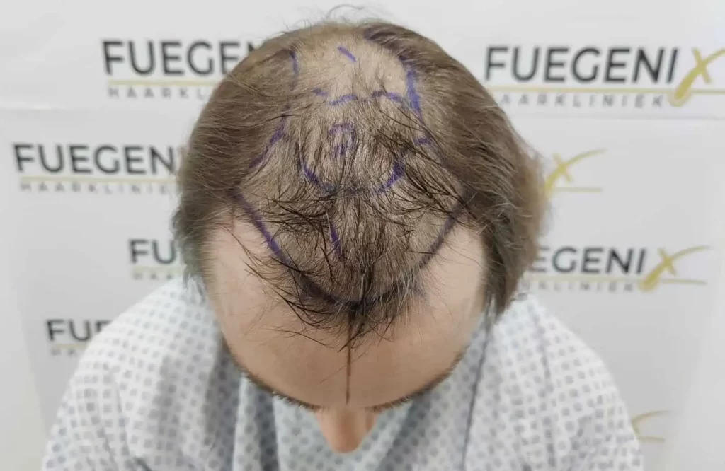 Before hair transplant
