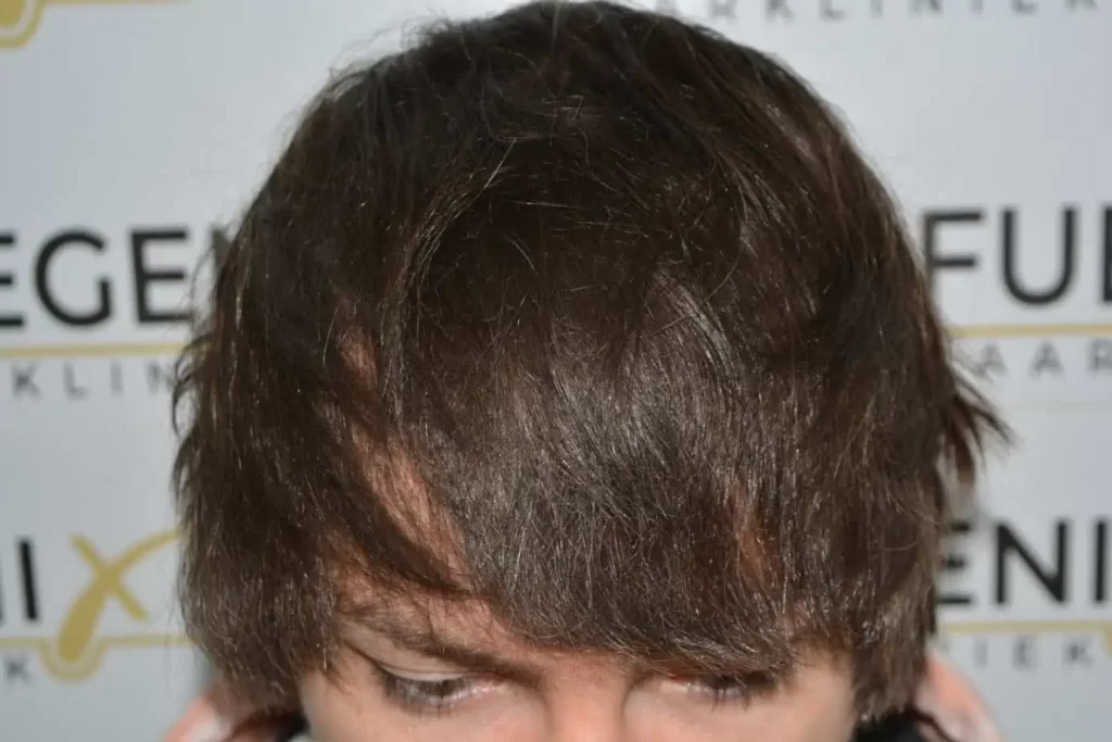 After hair transplant