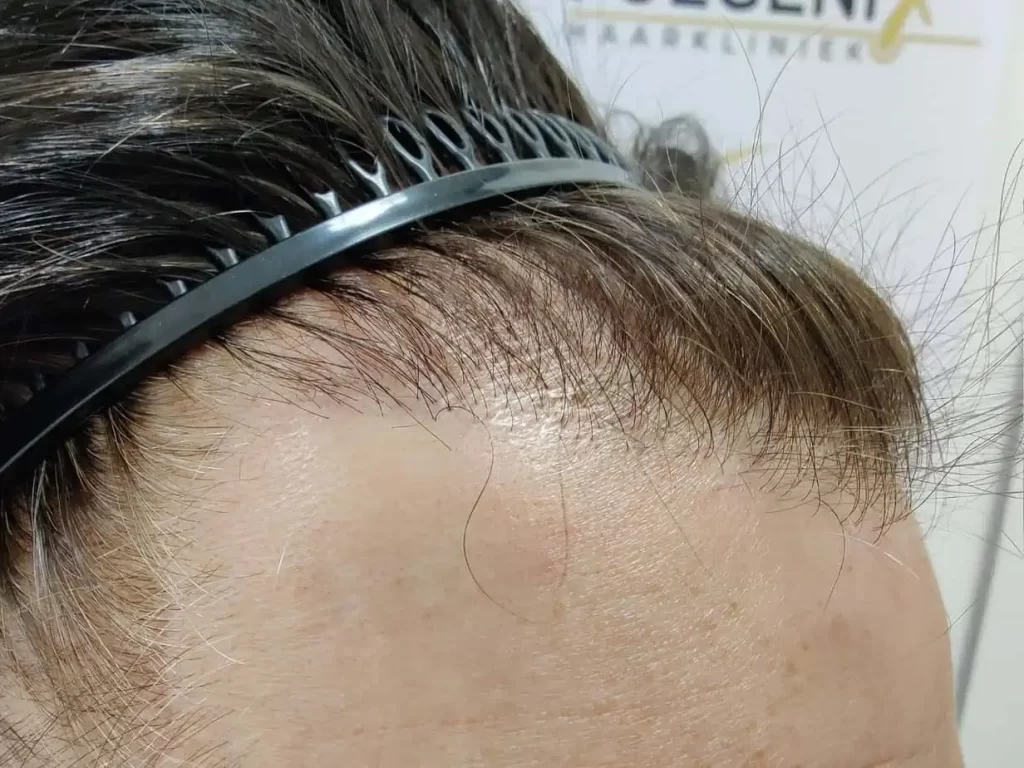 From Failed Hair Transplant To Shah Rukh Khan