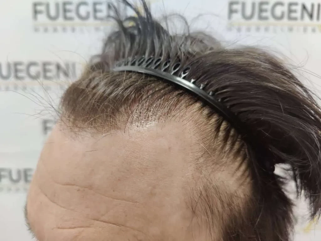 From Failed Hair Transplant To Shah Rukh Khan