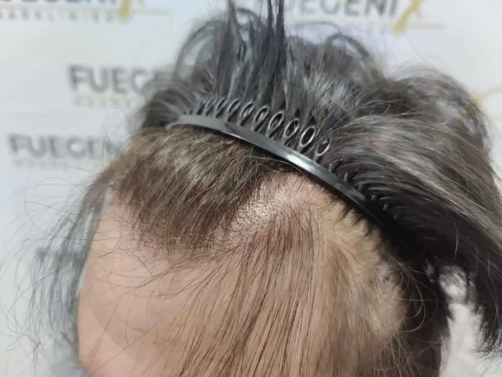 From Failed Hair Transplant To Shah Rukh Khan