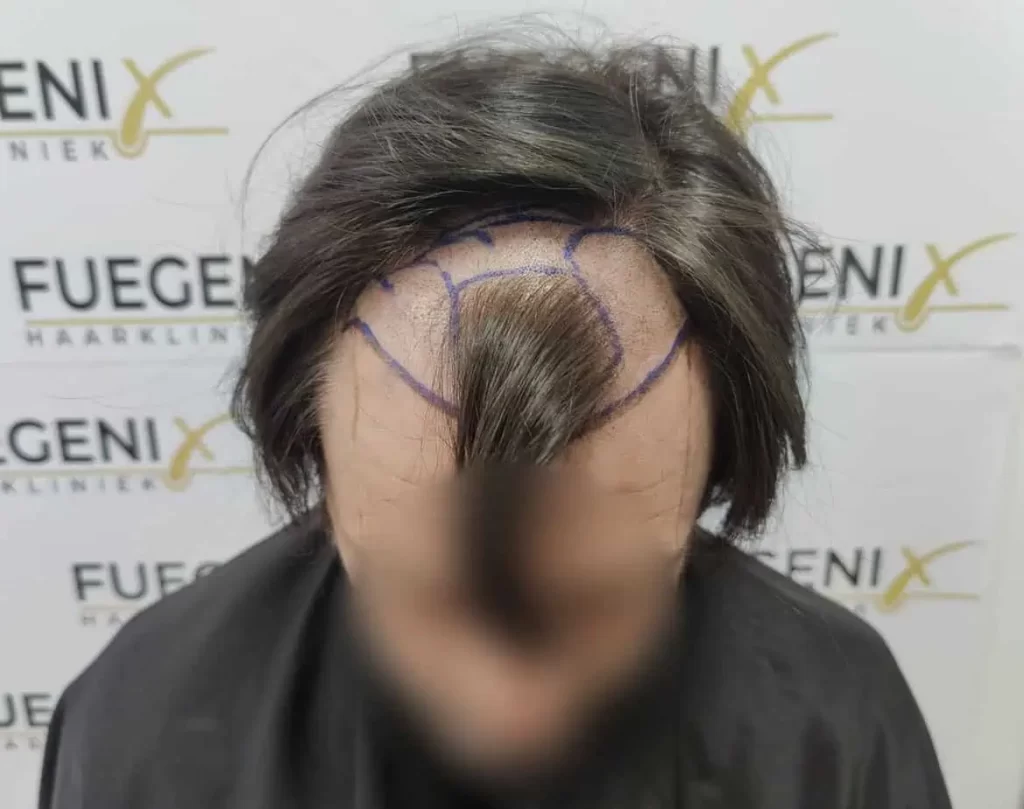 From Failed Hair Transplant To Shah Rukh Khan