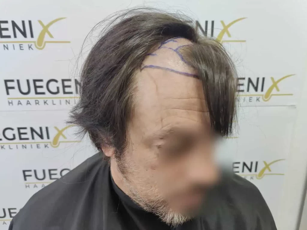 From Failed Hair Transplant To Shah Rukh Khan