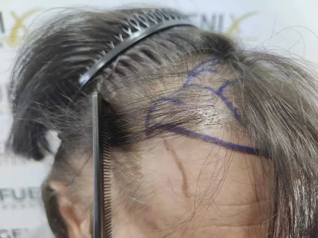 From Failed Hair Transplant To Shah Rukh Khan