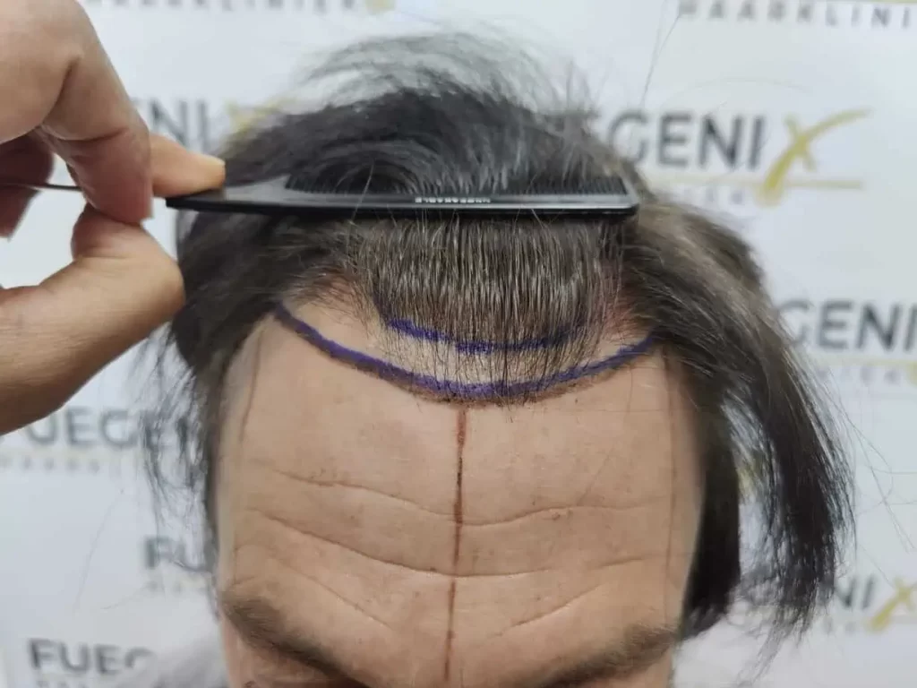 From failed hair transplant to Shah Rukh Khan — before