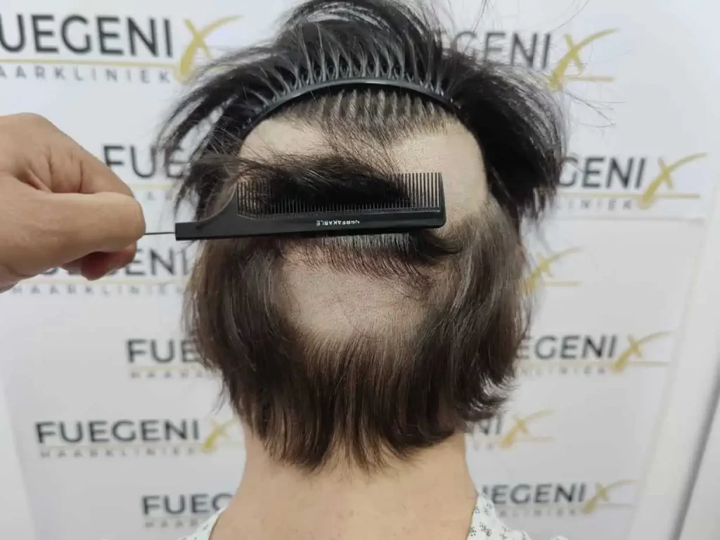 From Failed Hair Transplant To Shah Rukh Khan
