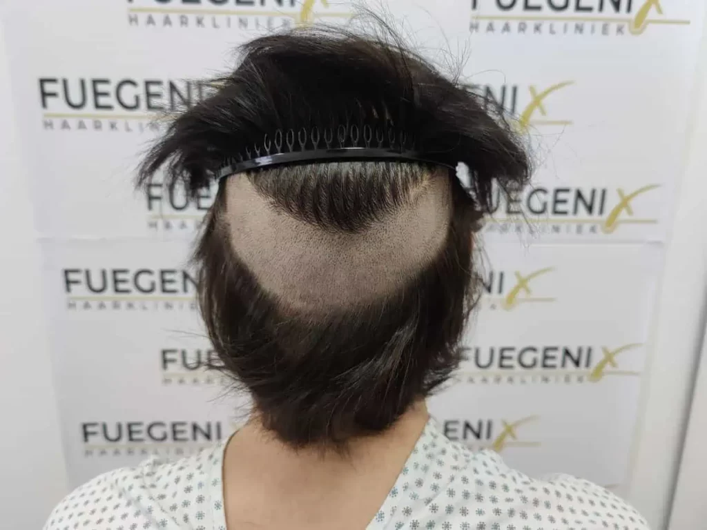 From Failed Hair Transplant To Shah Rukh Khan