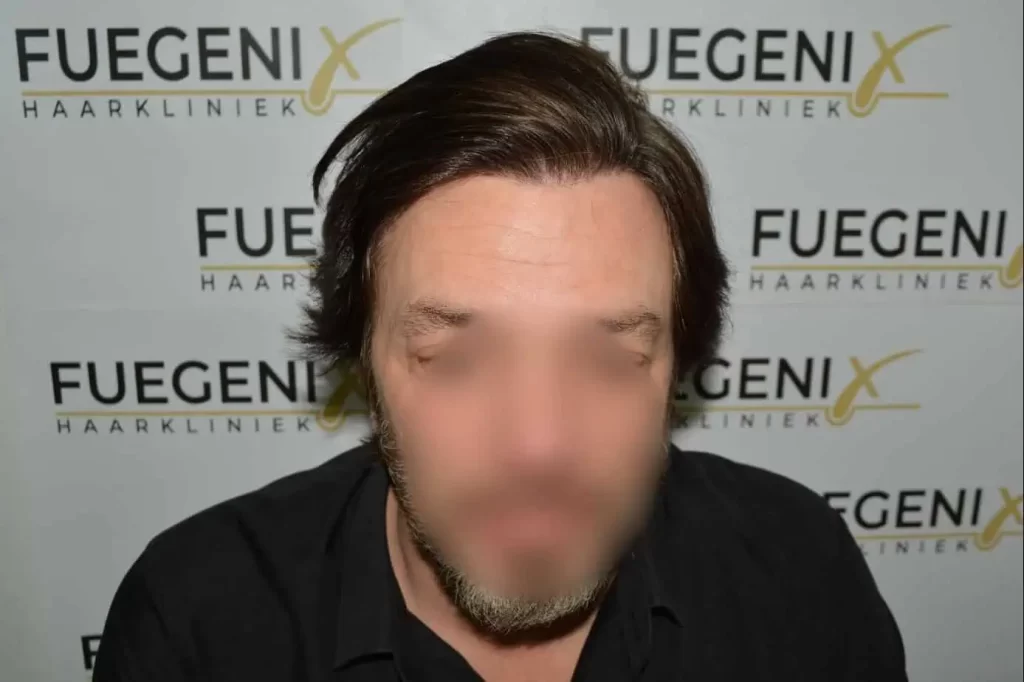 From Failed Hair Transplant To Shah Rukh Khan