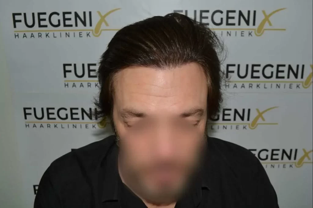 From Failed Hair Transplant To Shah Rukh Khan