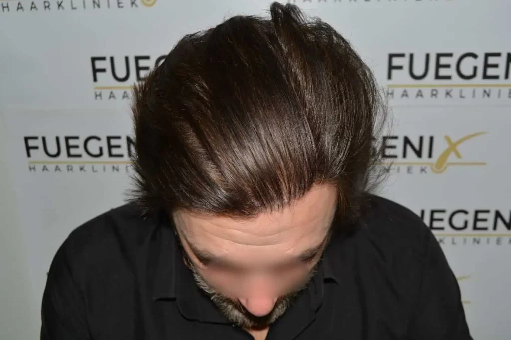 From Failed Hair Transplant To Shah Rukh Khan