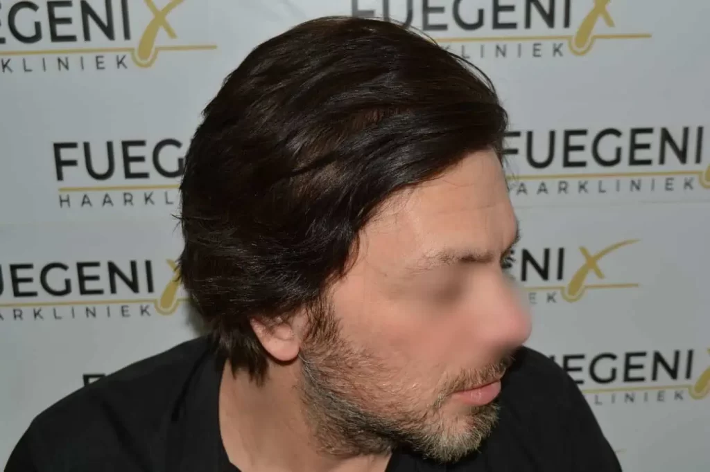 From Failed Hair Transplant To Shah Rukh Khan