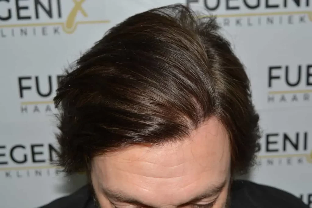 From Failed Hair Transplant To Shah Rukh Khan