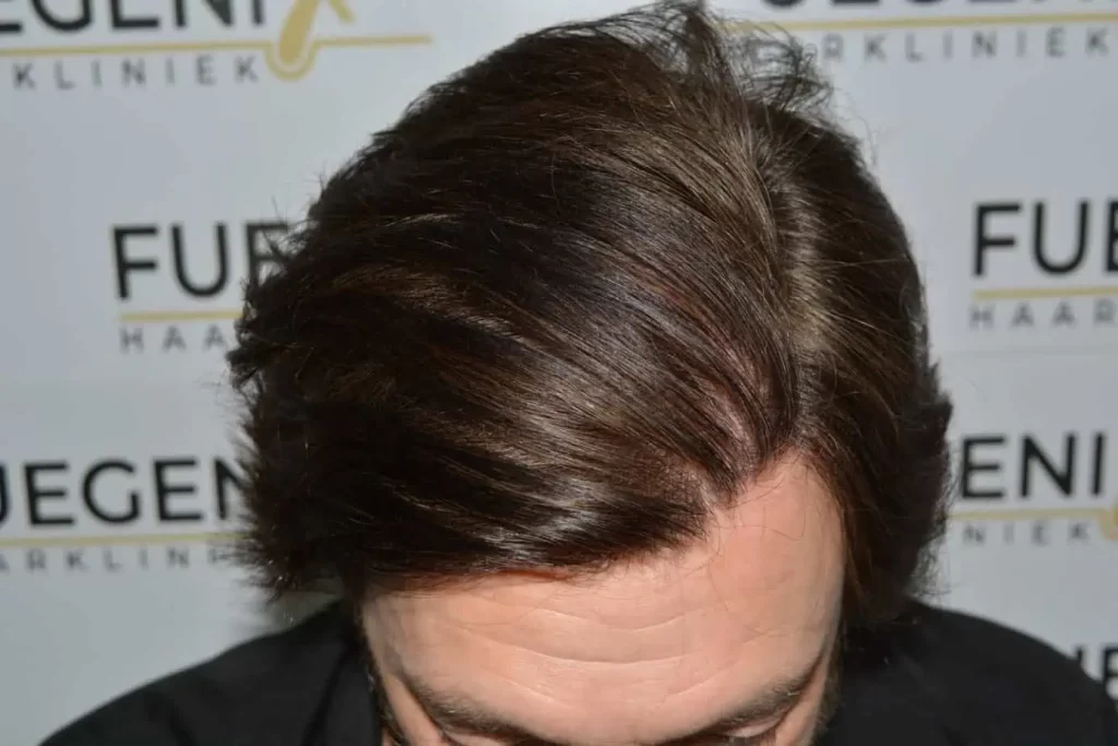From Failed Hair Transplant To Shah Rukh Khan