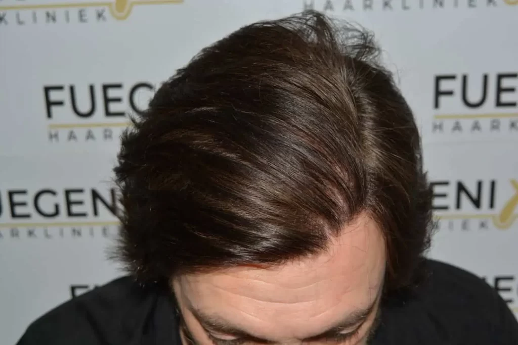 From Failed Hair Transplant To Shah Rukh Khan