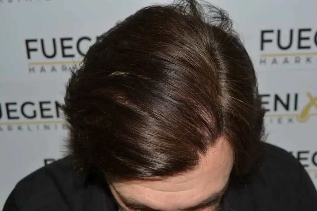 From Failed Hair Transplant To Shah Rukh Khan