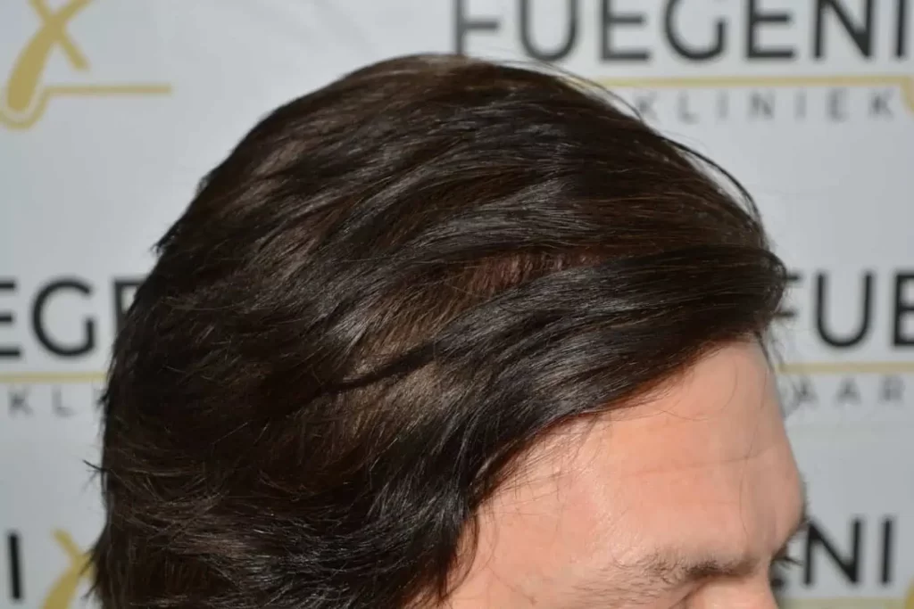 From Failed Hair Transplant To Shah Rukh Khan