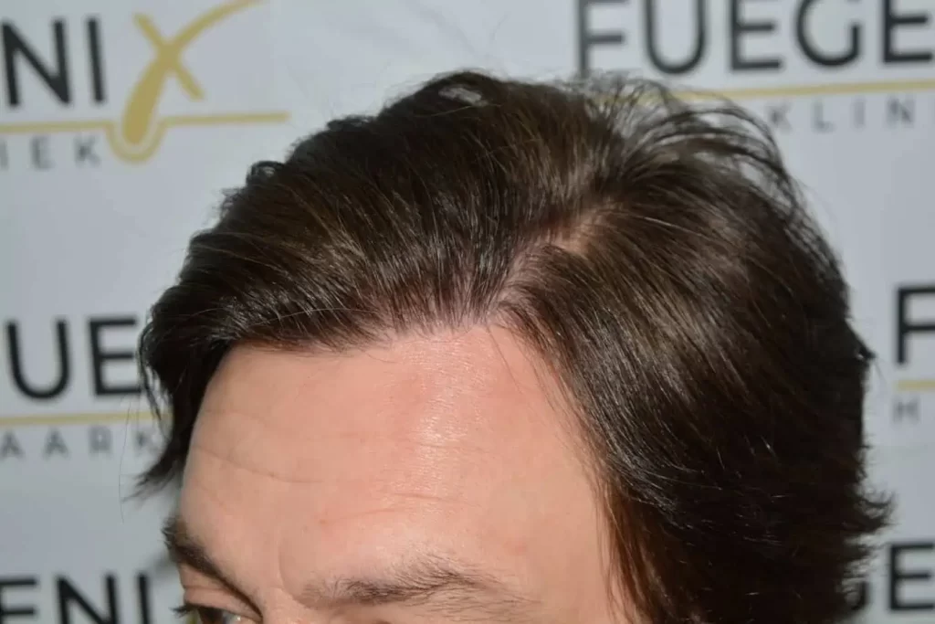 From Failed Hair Transplant To Shah Rukh Khan
