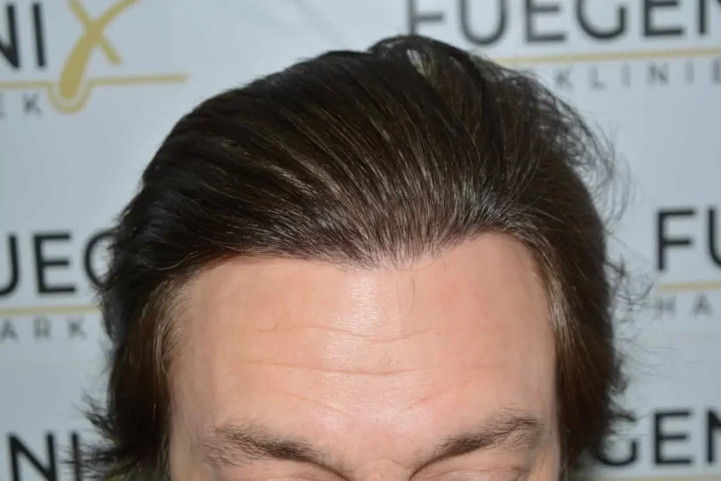 From failed hair transplant to Shah Rukh Khan — after