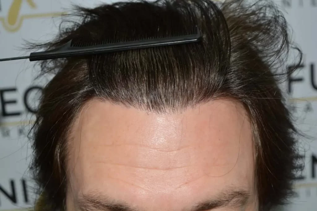 From Failed Hair Transplant To Shah Rukh Khan