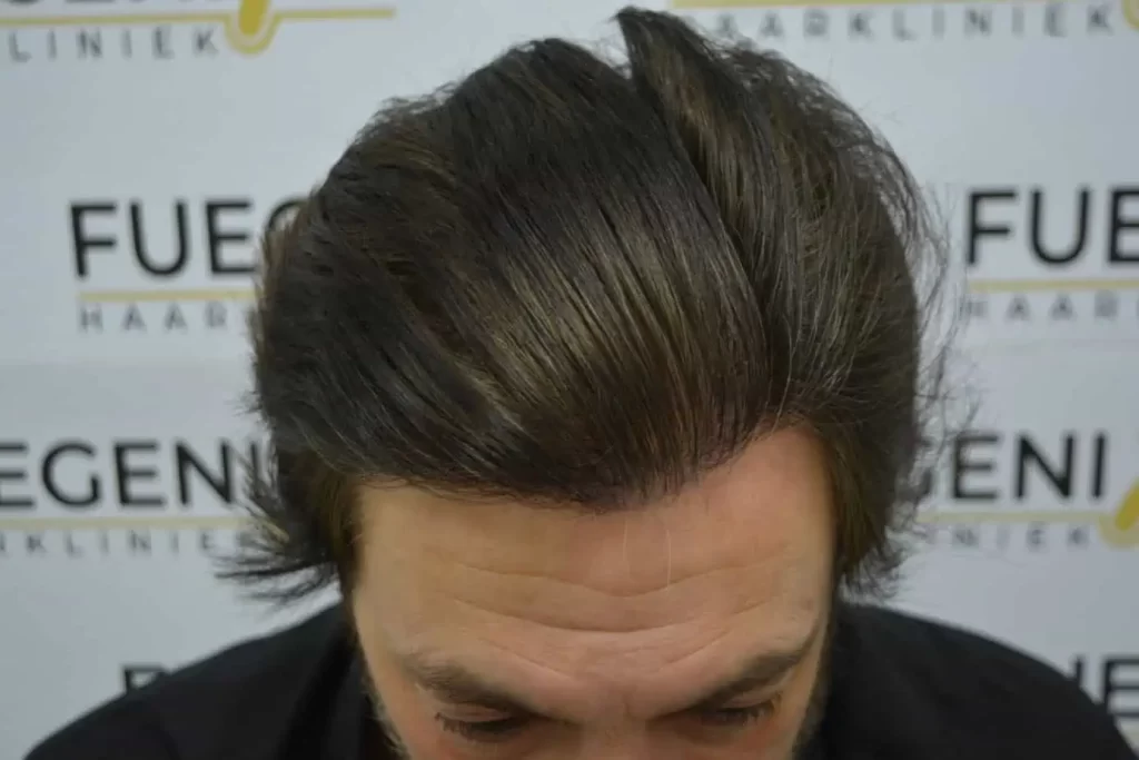 From Failed Hair Transplant To Shah Rukh Khan