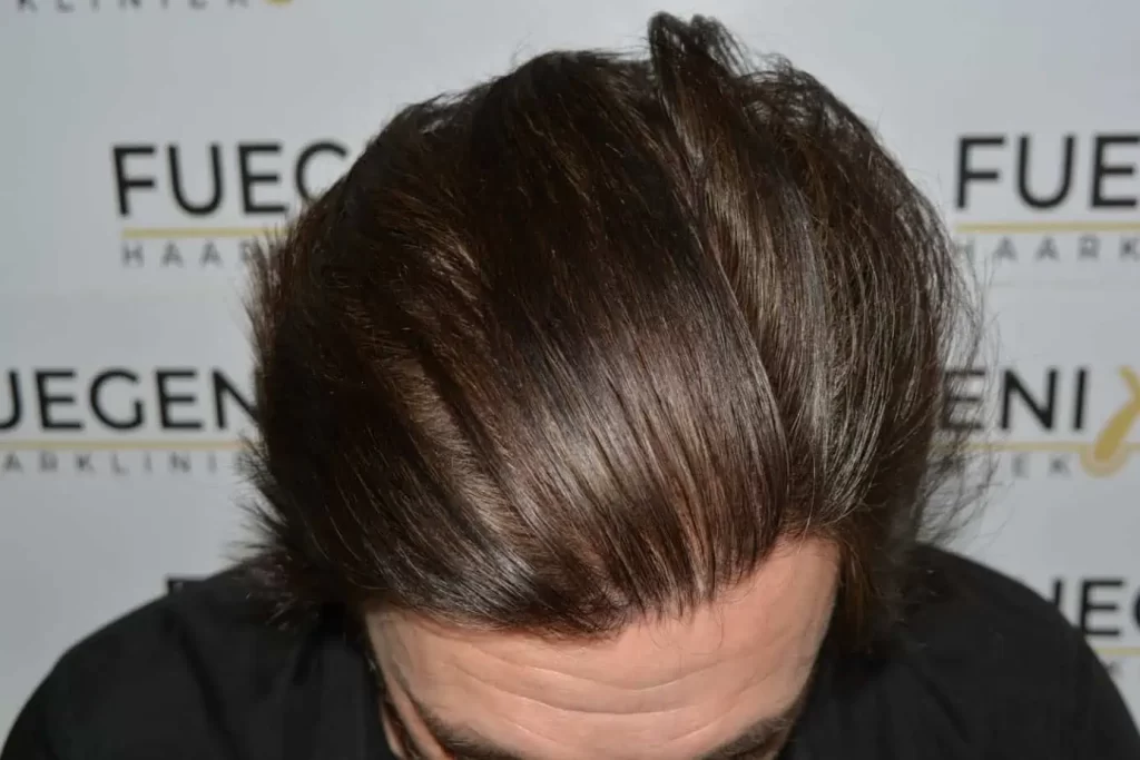 From Failed Hair Transplant To Shah Rukh Khan