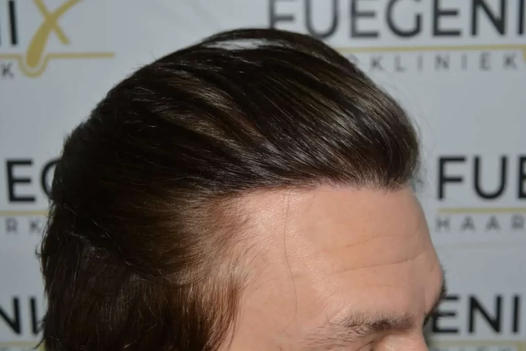 From Failed Hair Transplant To Shah Rukh Khan