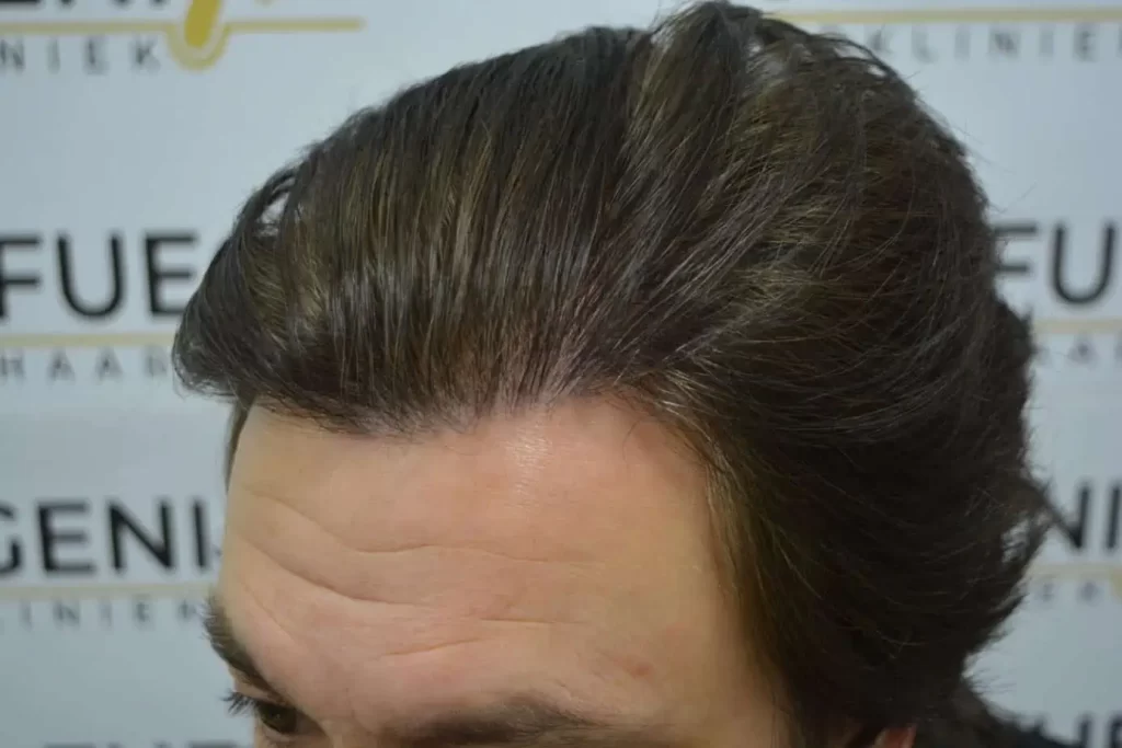 From Failed Hair Transplant To Shah Rukh Khan