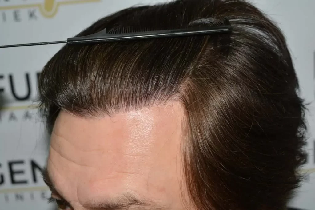From Failed Hair Transplant To Shah Rukh Khan