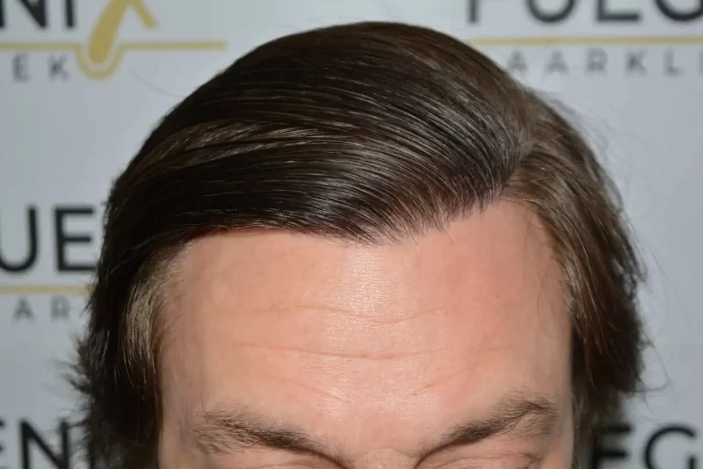 From Failed Hair Transplant To Shah Rukh Khan