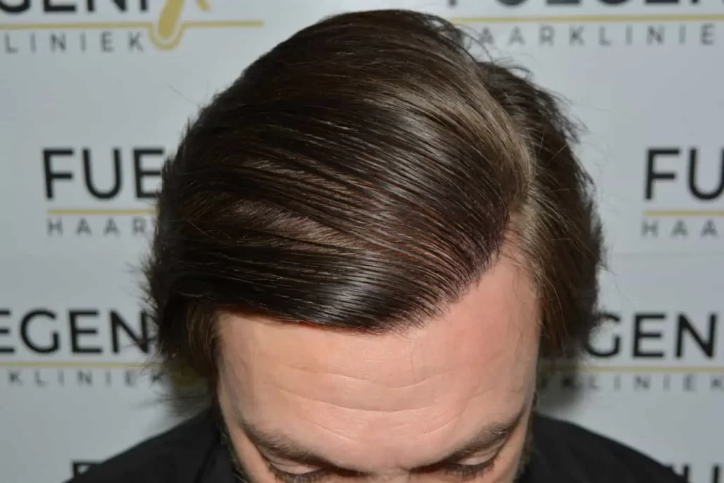From Failed Hair Transplant To Shah Rukh Khan