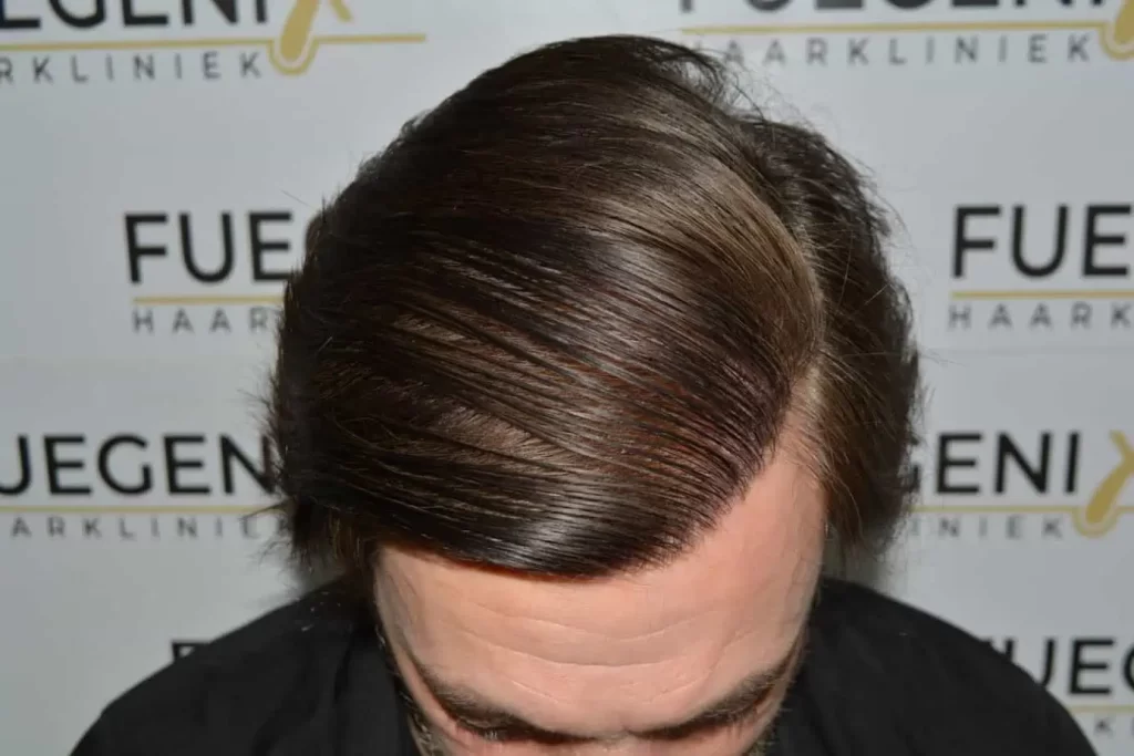 From Failed Hair Transplant To Shah Rukh Khan