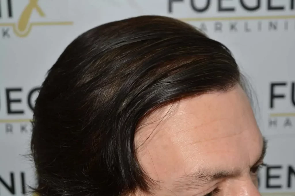 From Failed Hair Transplant To Shah Rukh Khan