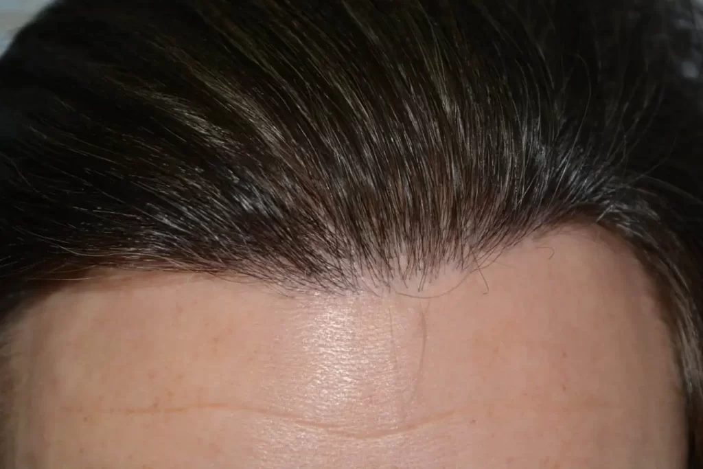 From Failed Hair Transplant To Shah Rukh Khan