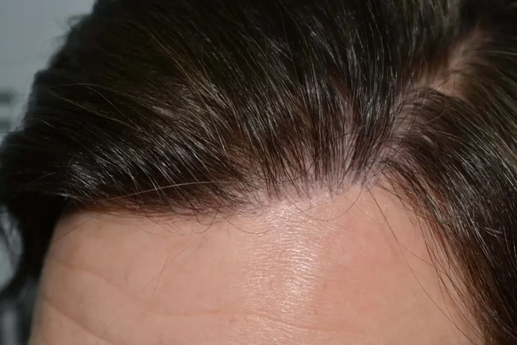 From Failed Hair Transplant To Shah Rukh Khan